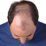 home remedies to treat baldness