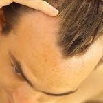 A Snapshot of the Treatment of Receding Hairline