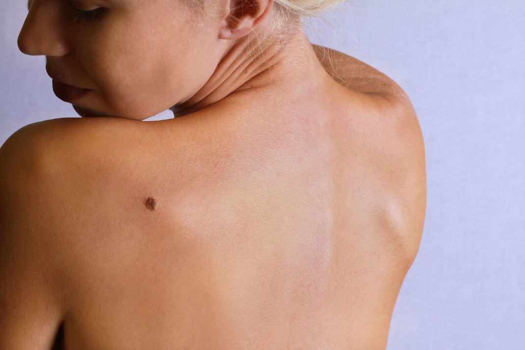 10 Home Remedies to get rid Of Skin Tags