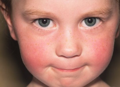 Skin Disorders in Children Symptoms Skin Disorders in Children Symptoms