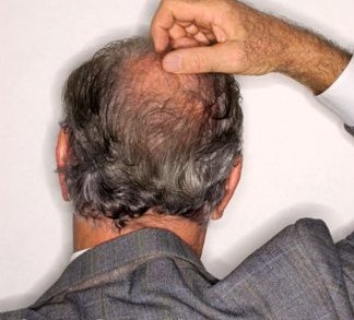 Alopcecia-areata-treatment Alopcecia-areata-treatment